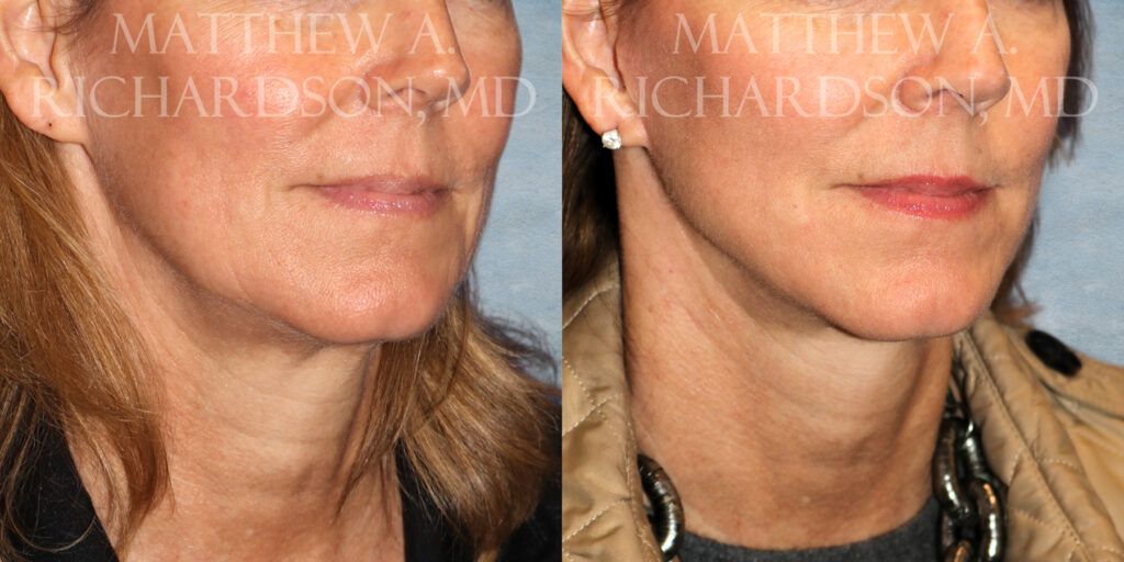 Neck Lift Before and After photo by Texas Facial Aesthetics in Frisco TX