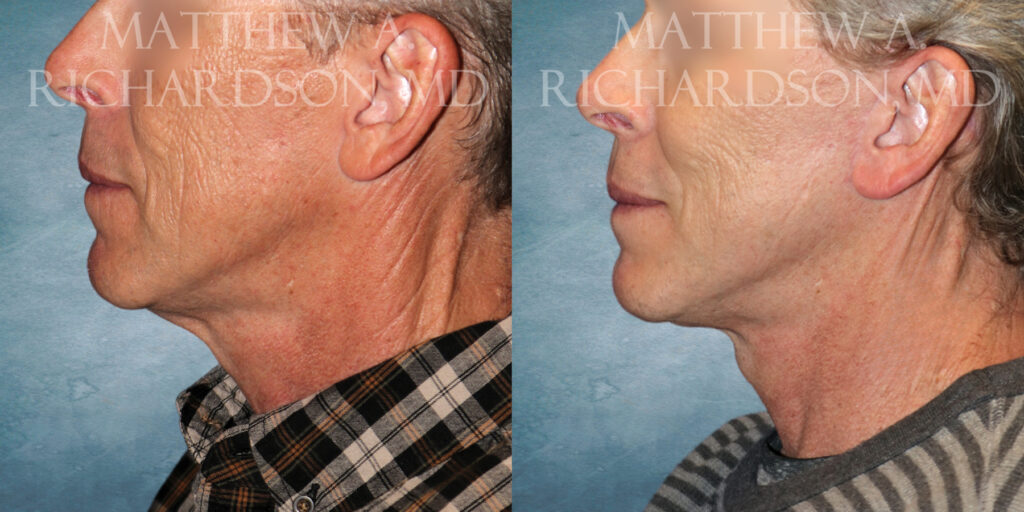 Neck Lift Before and After photo by Texas Facial Aesthetics in Frisco TX