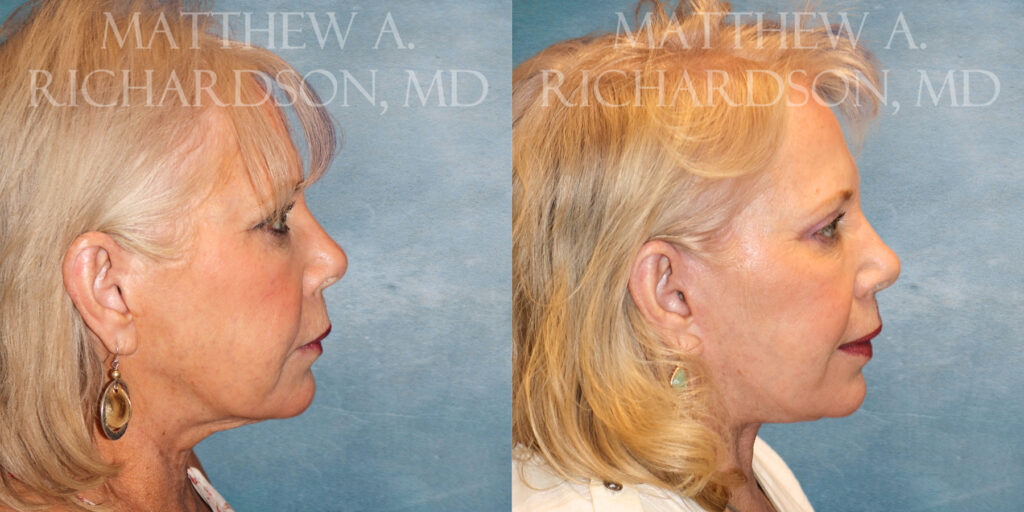 Neck Lift Before and After photo by Texas Facial Aesthetics in Frisco TX