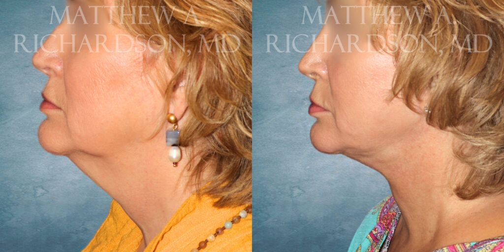 Neck Lift Before and After photo by Texas Facial Aesthetics in Frisco TX