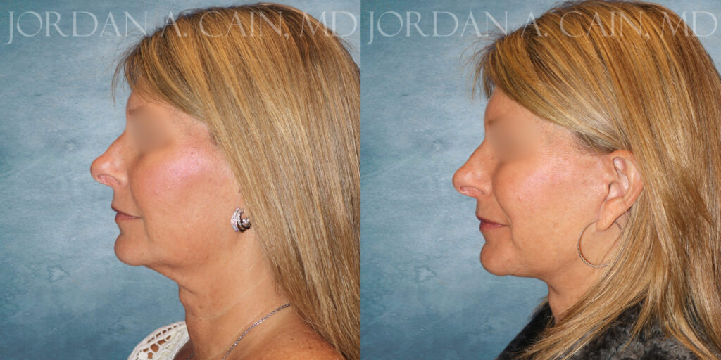 Neck Lift Before and After photo by Texas Facial Aesthetics in Frisco TX