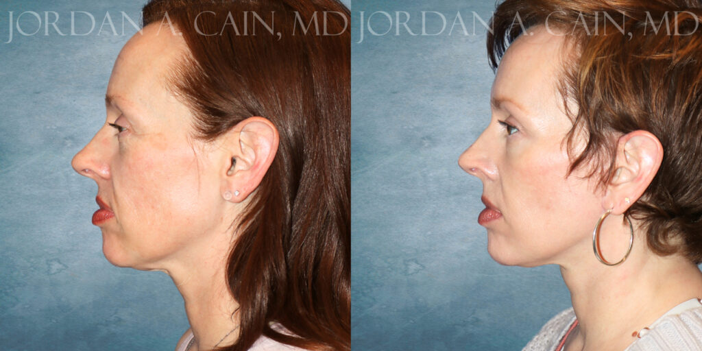 Neck Lift Before and After photo by Texas Facial Aesthetics in Frisco TX