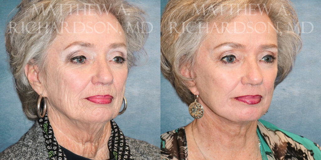 Neck Lift Before and After photo by Texas Facial Aesthetics in Frisco TX