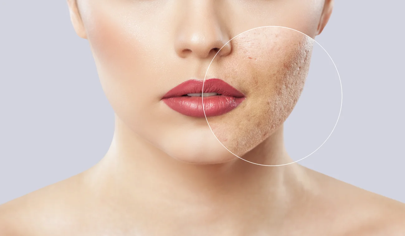 A young girl with a problem skin. Photo before and after treatment for acne. scar revision featured image A young girl with a problem skin. Photo before and after treatment for acne. scar revision featured image