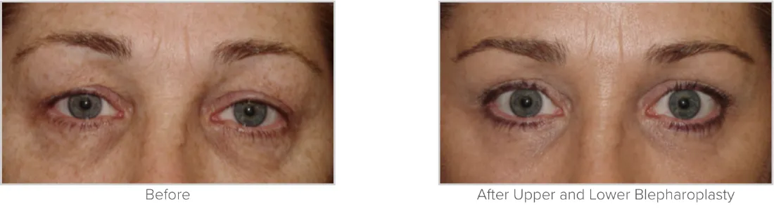 Blepharoplasty before and after performed by Matthew A. Richardson, MD