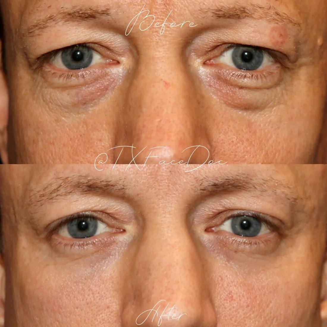 Blepharoplasty before and after performed by Matthew A. Richardson, MD