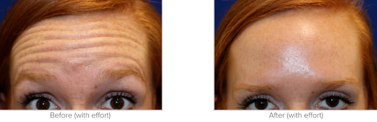 Botox Before and After Photo Performed by Texas Facial Aesthetics