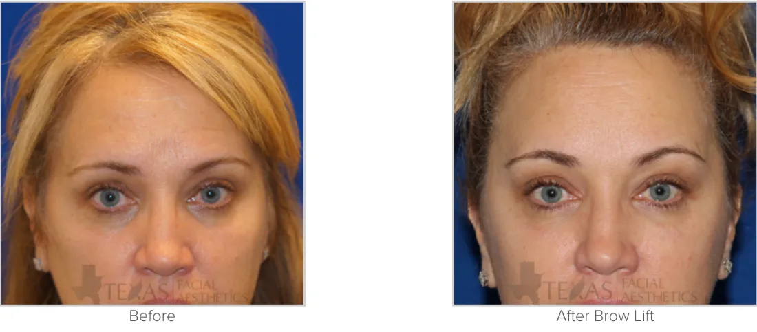 Brow Lift before and after performed by Matthew A. Richardson, MD