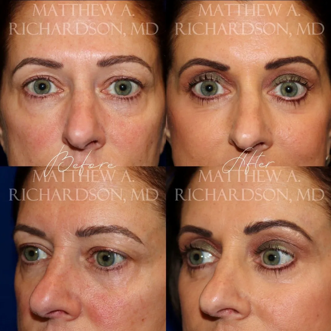 Brow Lift before and after performed by Matthew A. Richardson, MD