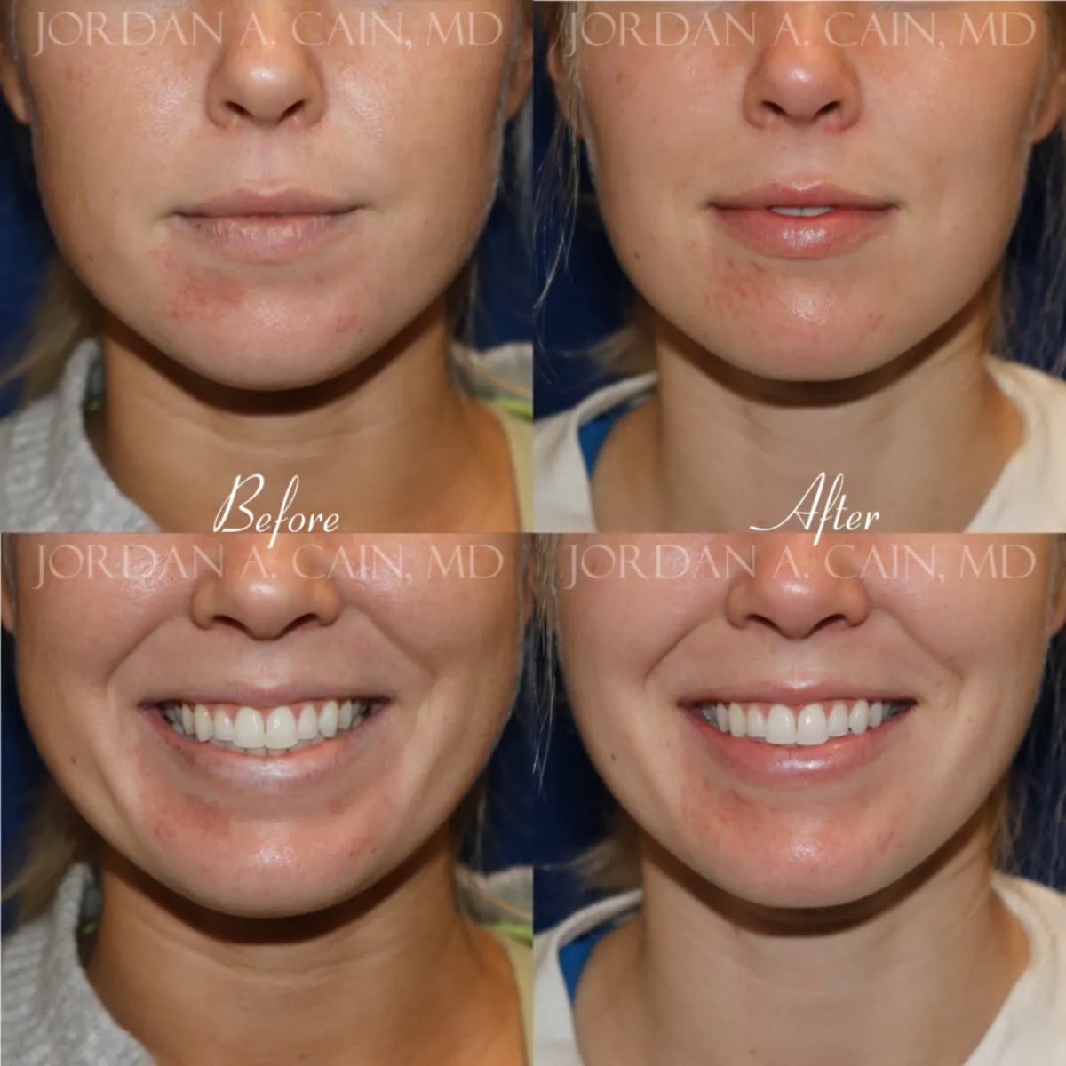 Buccal Fat Reduction Before and After Performed by Jordan A. Cain, MD