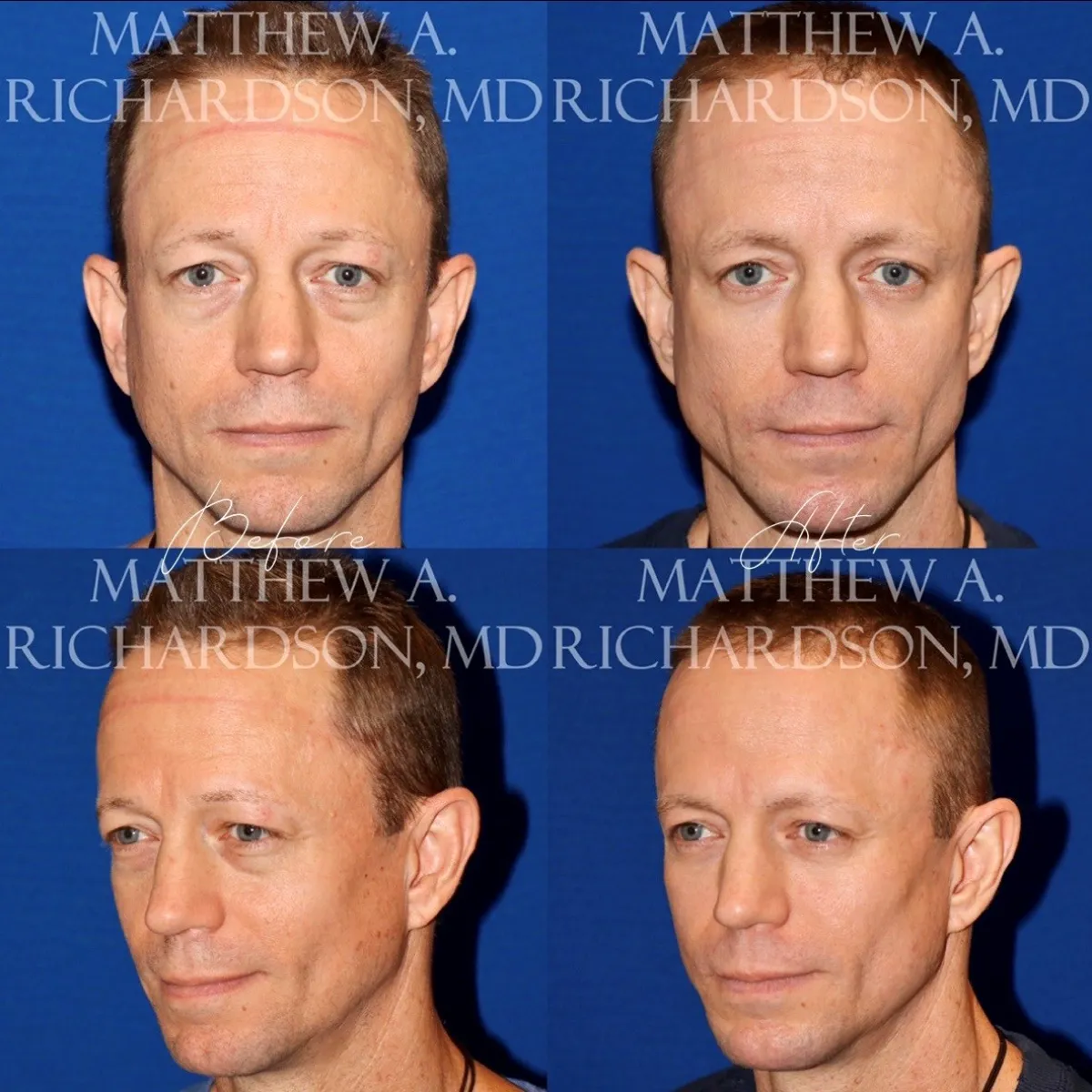 Cheek Augmentation Before After Photo Performed by Matthew A. Richardson, MD.
