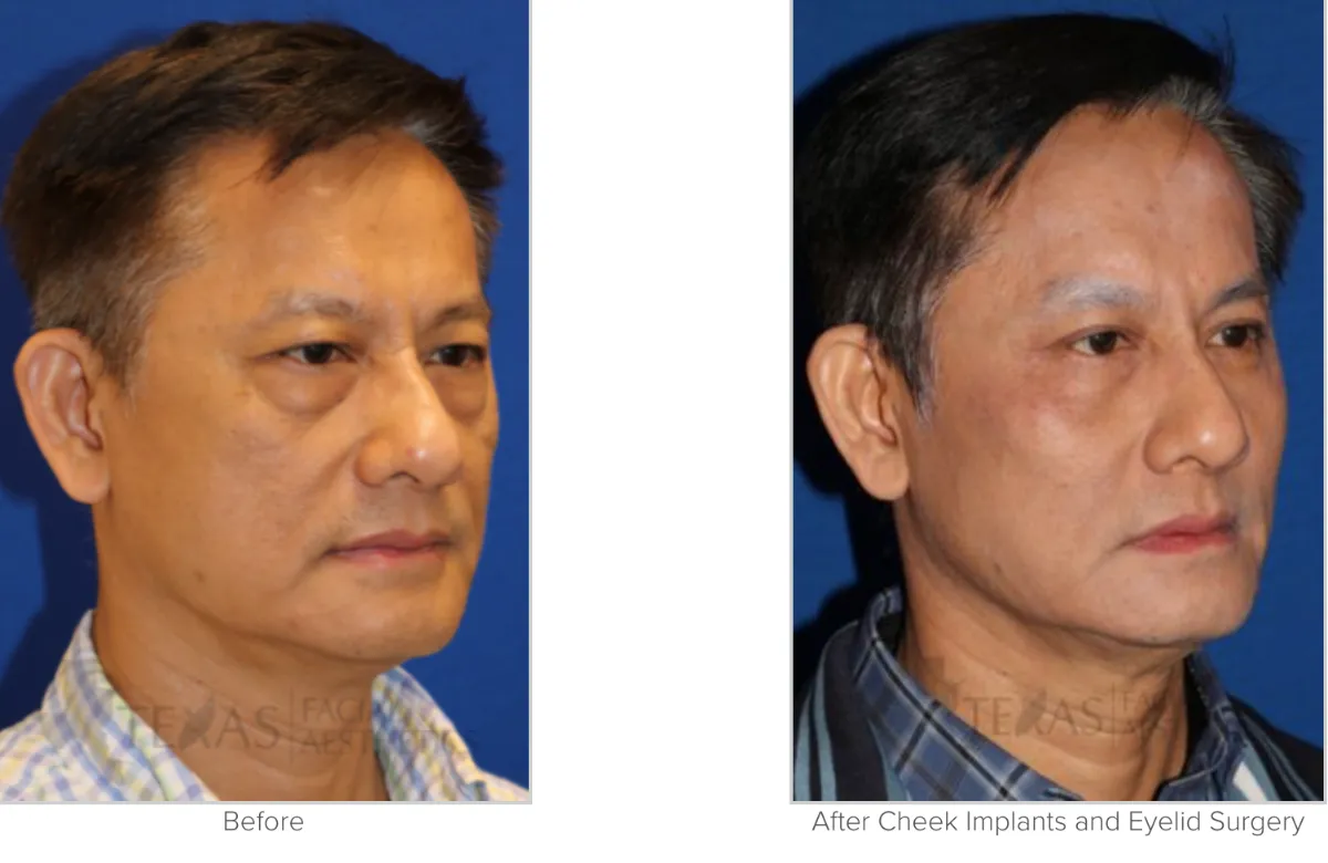 Cheek Augmentation Before After Photo Performed by Matthew A. Richardson, MD