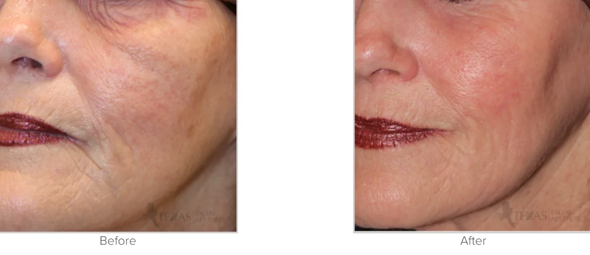 Chemical Peel Before and After Photo Performed by Texas Facial Aesthetics