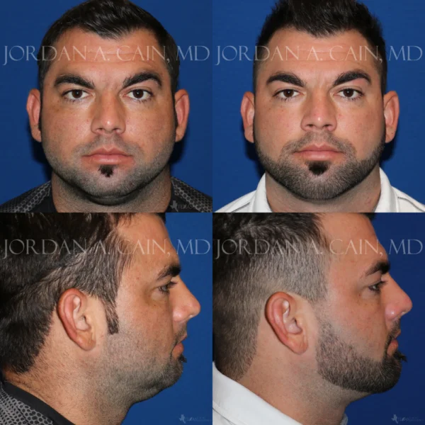 Chin Augmentation Before and After Performed by Jordan A. Cain, MD ()