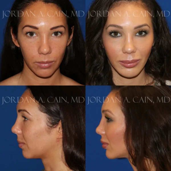 Chin Augmentation Before and After Performed by Jordan A. Cain, MD
