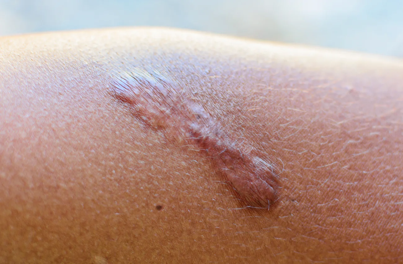 Close up Keloid scar (Hypertrophic Scar) on skin. Can use for skin imperfections concepts. keloid removal featured image
