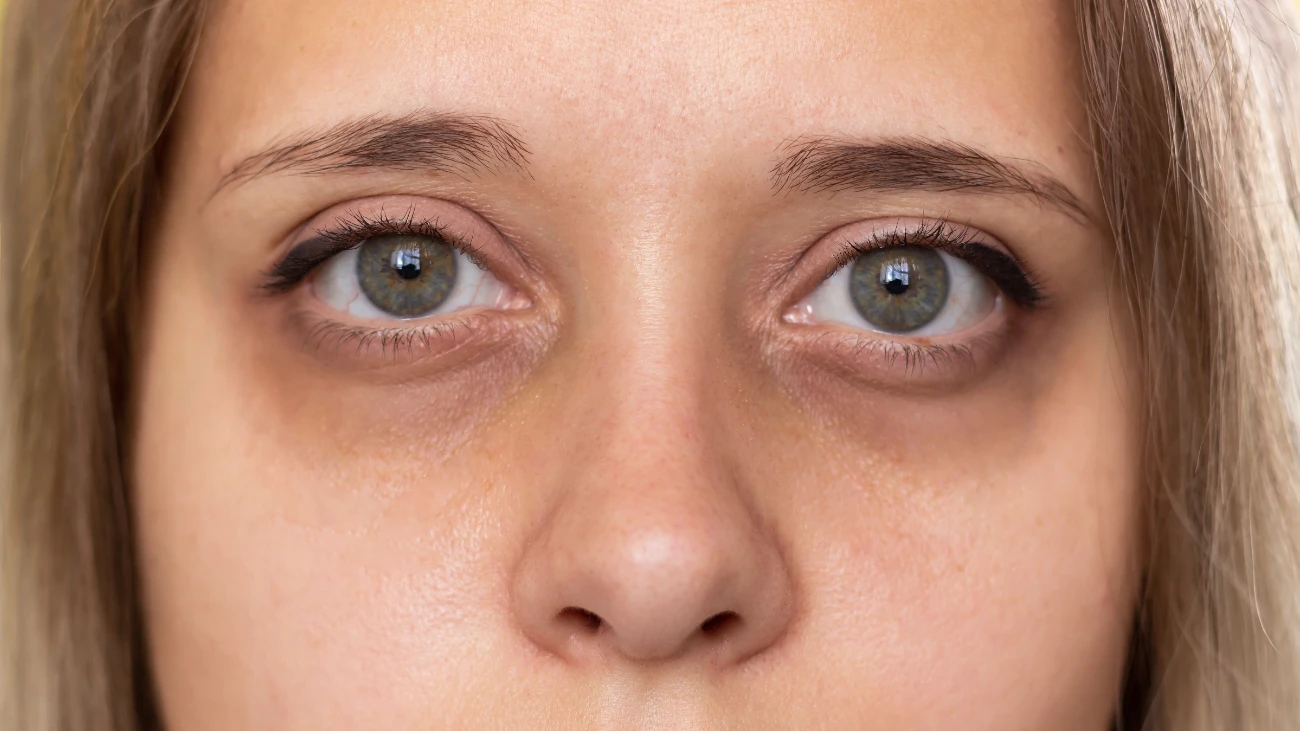 Cropped shot of a young woman's face. Green eyes with dark circles under the eyes and with red capillaries. dark eye circles
