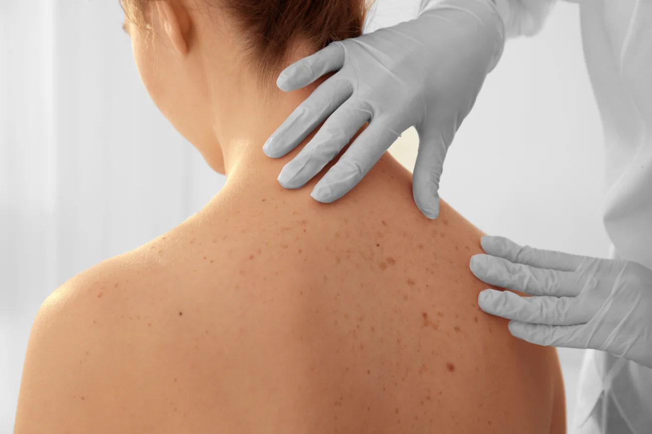 Dermatologist examining patient in clinic, closeup. mole removal featured image