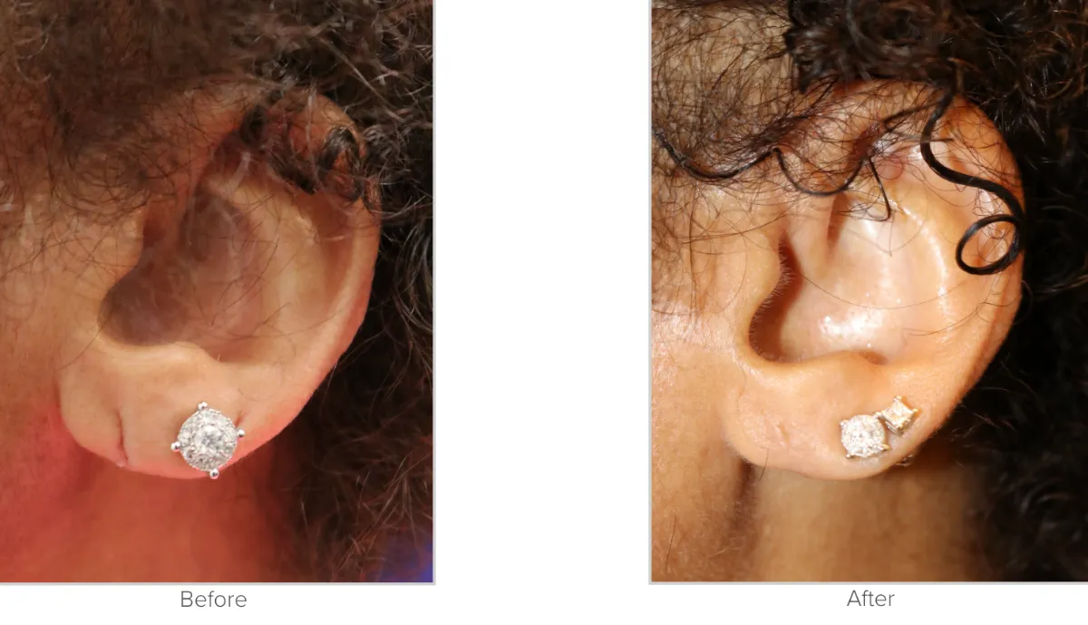 Earlobe Repair Before and After Photo Performed by Texas Facial Aesthetics