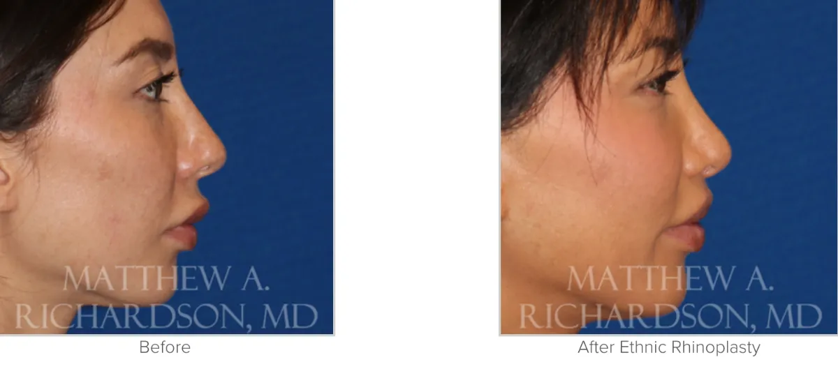 Ethnic Rhinoplasty Before and After Photo Performed by Matthew A. Richardson, MD