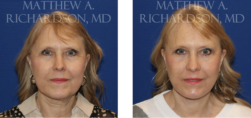 Facelift Before and After Performed by Matthew A. Richardson, MD