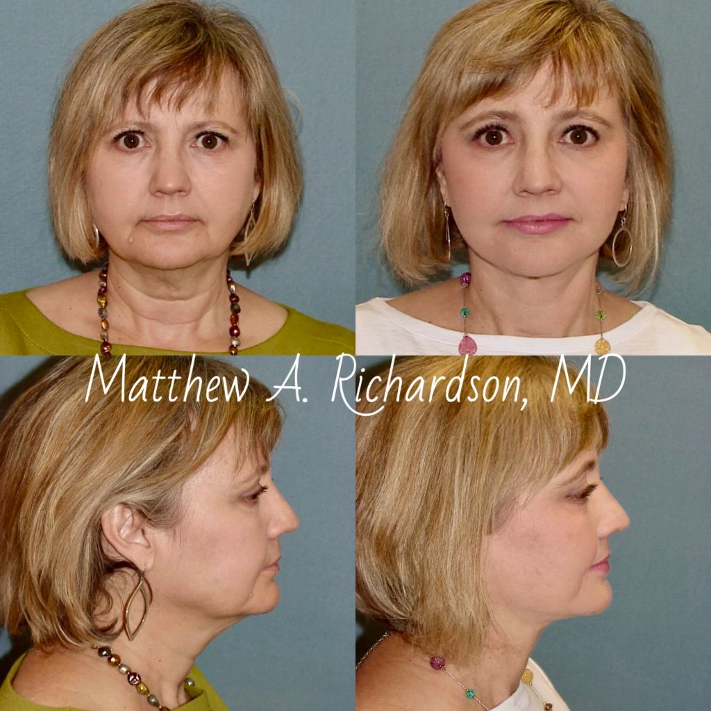 Facelift Before and After Photo Performed by Dr Matthew A. Richardson