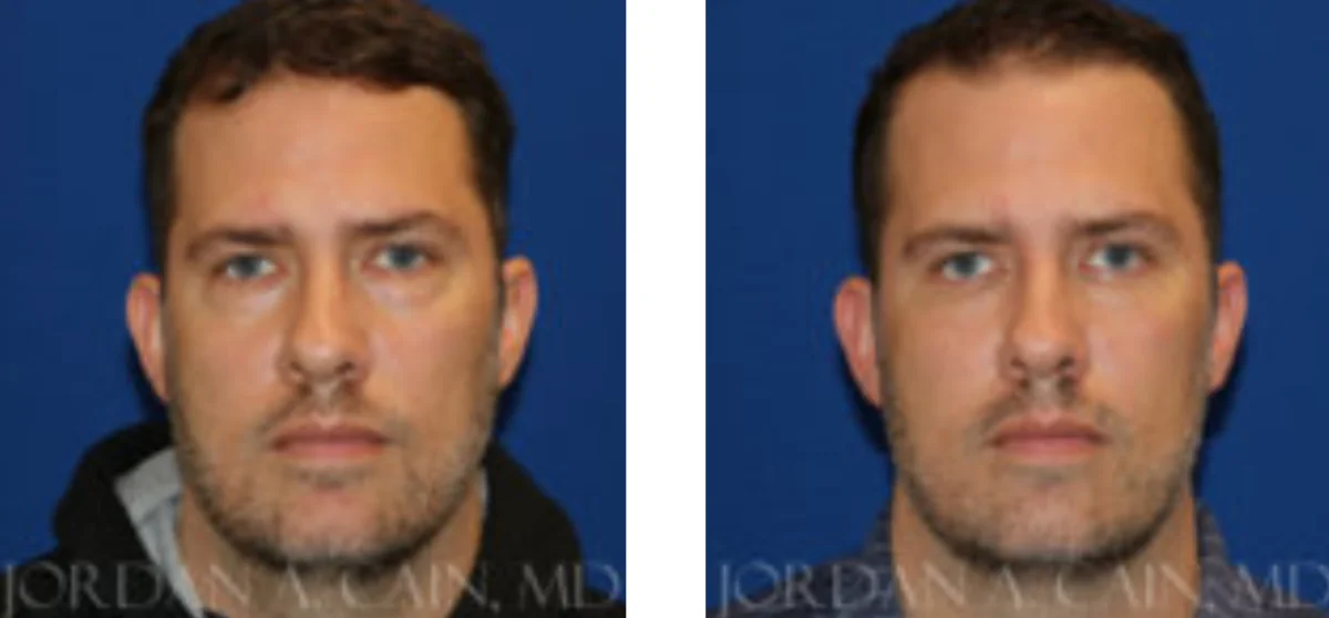 Facial Fat Transfer Before and After Performed by Jordon A. Cain, MD