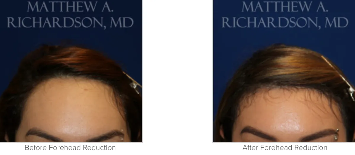 Forehead Reduction Before and After Performed by Matthew A. Richardson, MD