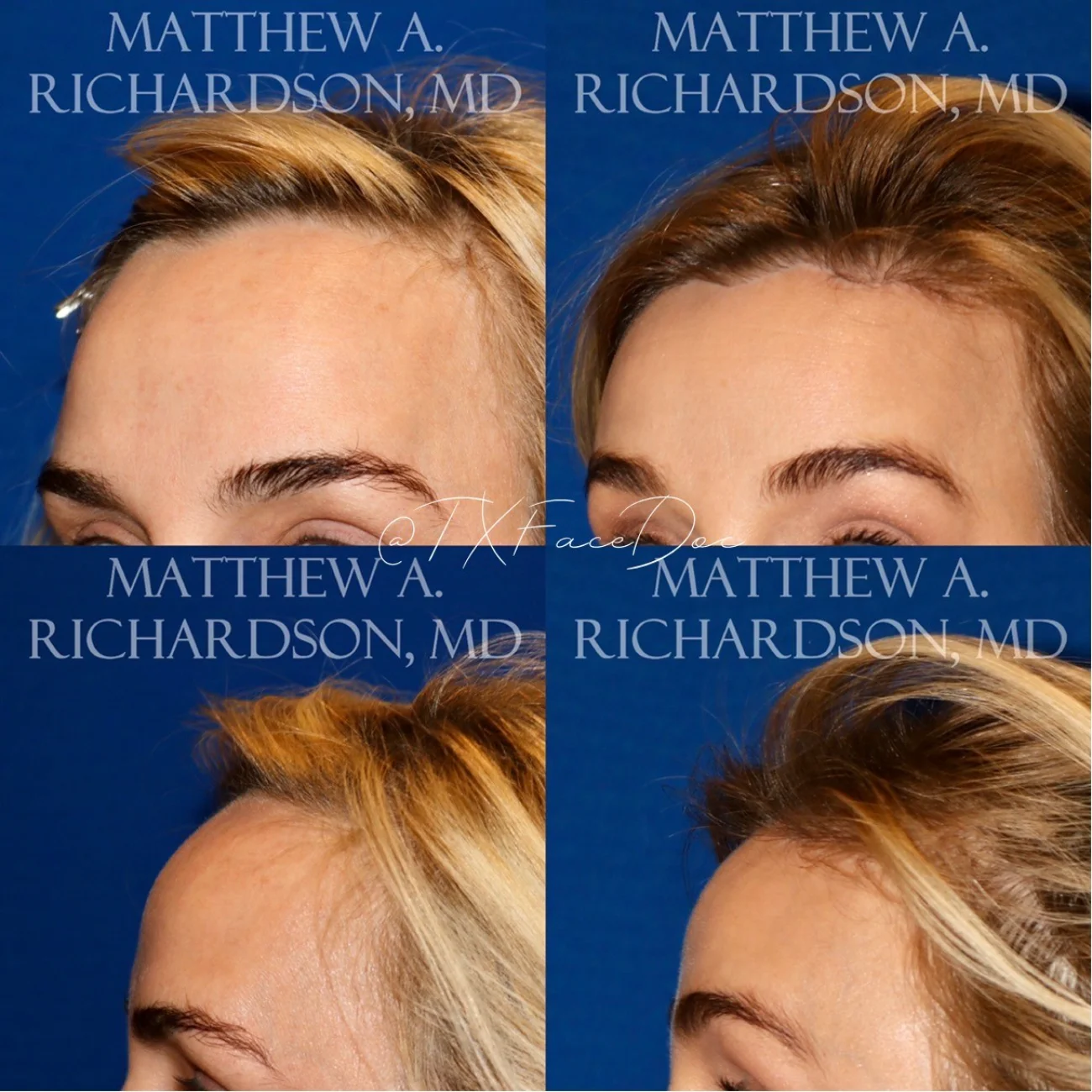 Hairline Lowering Surgery Before and After Performed by Matthew A. Richardson, MD