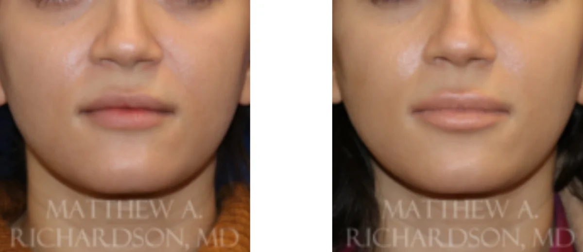 Juvederm Before and After Photo Performed by Matthew A. Richardson, MD