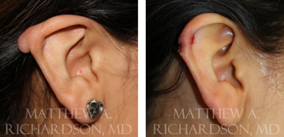 Keloid Before and After Photo Performed by Matthew A. Richardson, MD