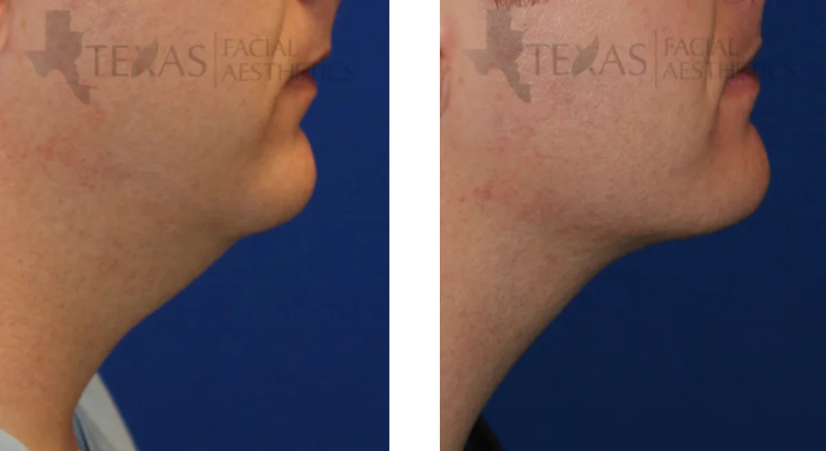 Kybella Before and After Performed by Texas Facial Aesthetics