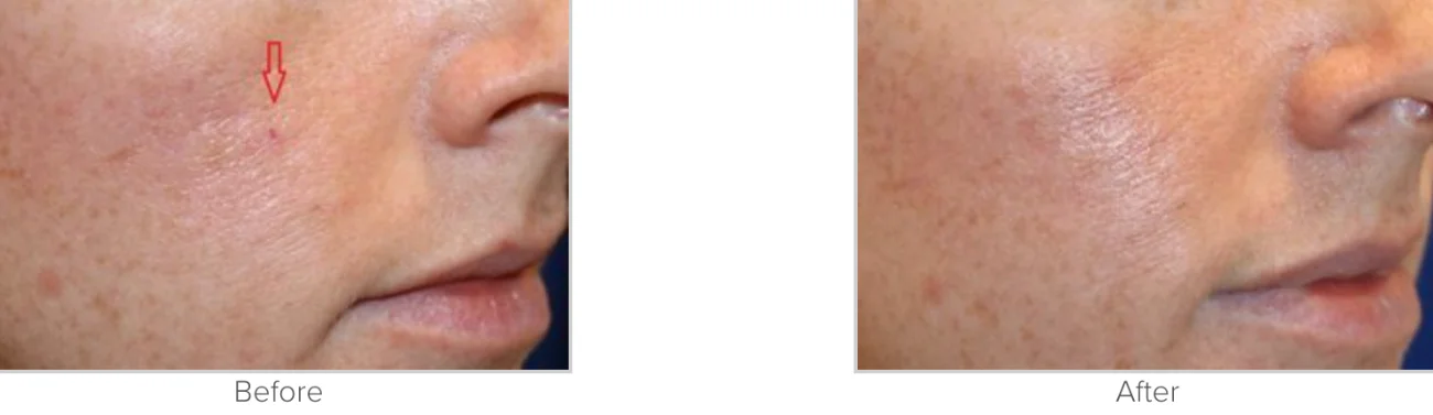 Laser Vein Removal Before and After Performed by Texas Facial Aesthetics