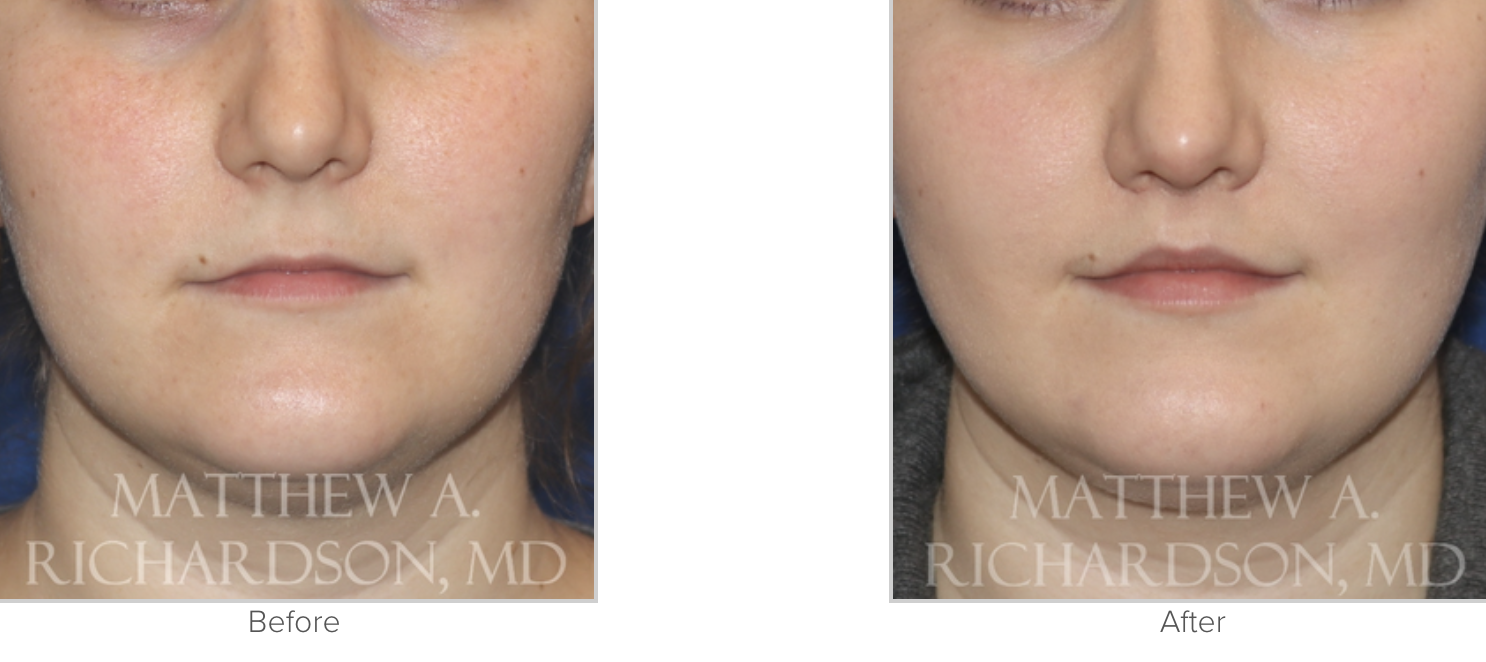 Lip Lift Before and After Performed by Matthew A. Richardson, MD