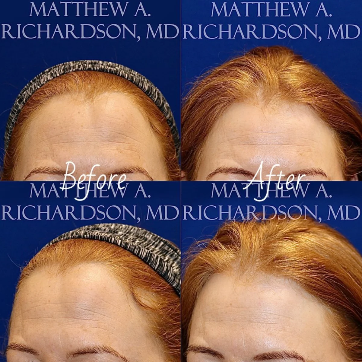Lipoma Before and After Performed by Matthew A. Richardson, MD