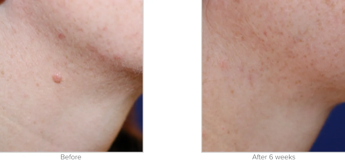 Mole removal before and After Performed by Matthew A. Richardson, MD