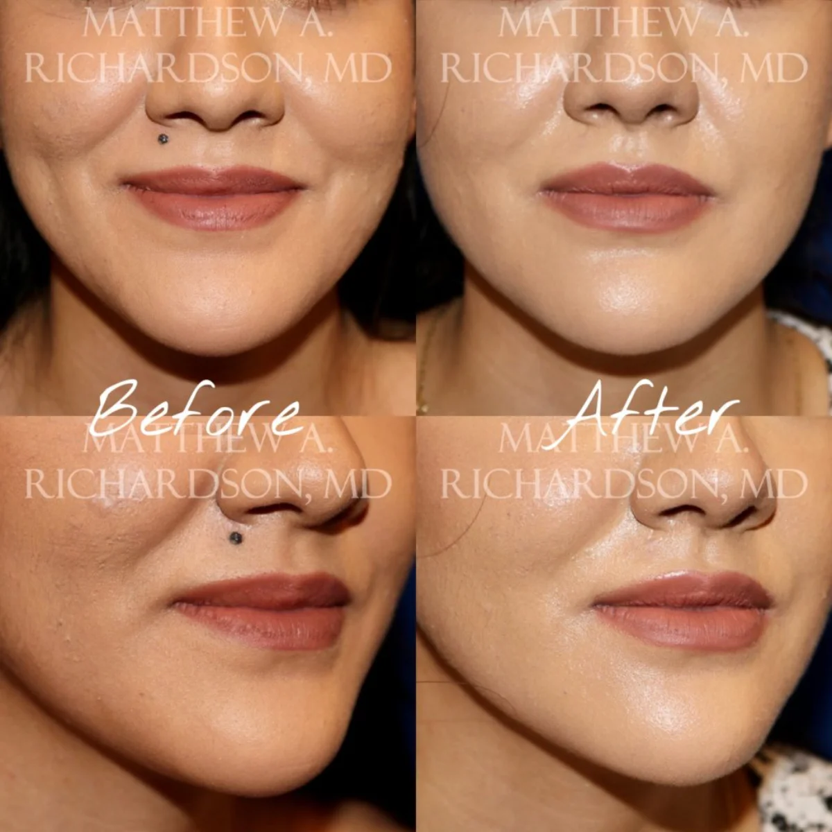 Mole removal before and After Performed by Matthew A. Richardson, MD