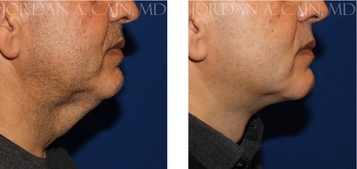 Neck Lift Before and After Photo Performed by Matthew Richardson, MD