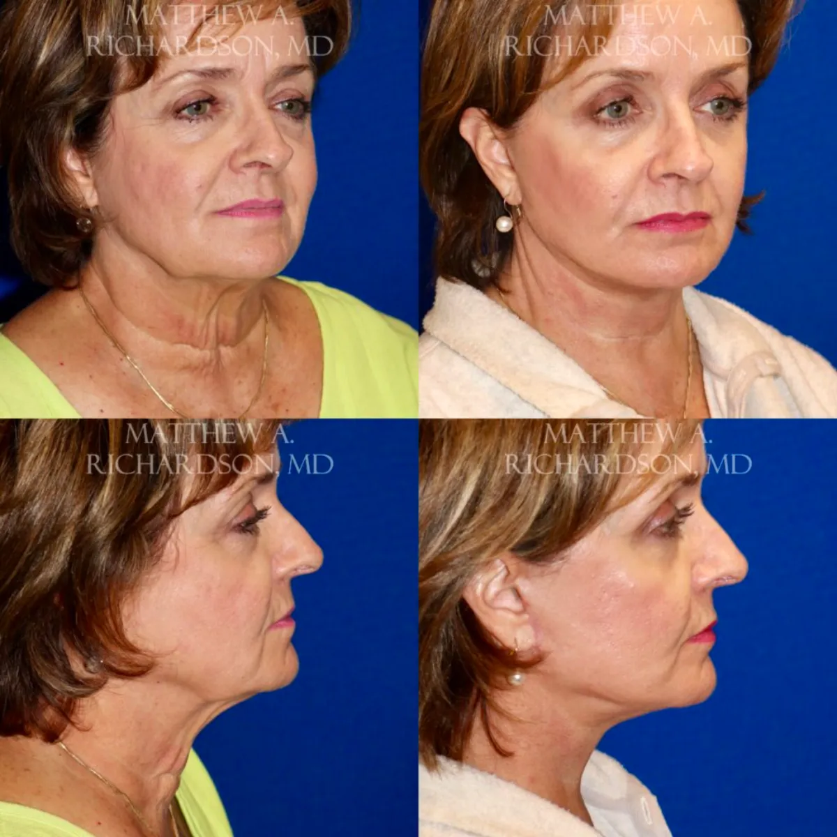 Neck Lift Before and After Photo Performed by Matthew Richardson, MD