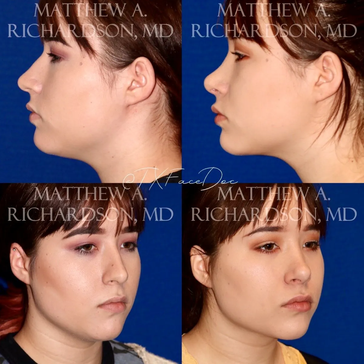 Neck Liposuction Before and After Performed by Matthew A. Richardson, MD