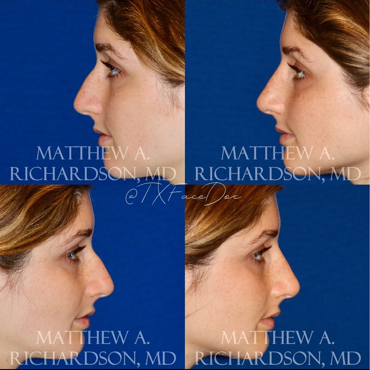 Non Surgical nose job Before and After Performed by Matthew A. Richardson, MD
