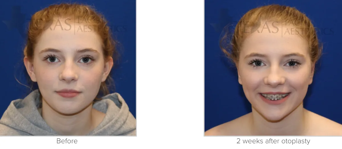Otoplasty Before and After Photos Performed by Matthew A. Richardson, MD