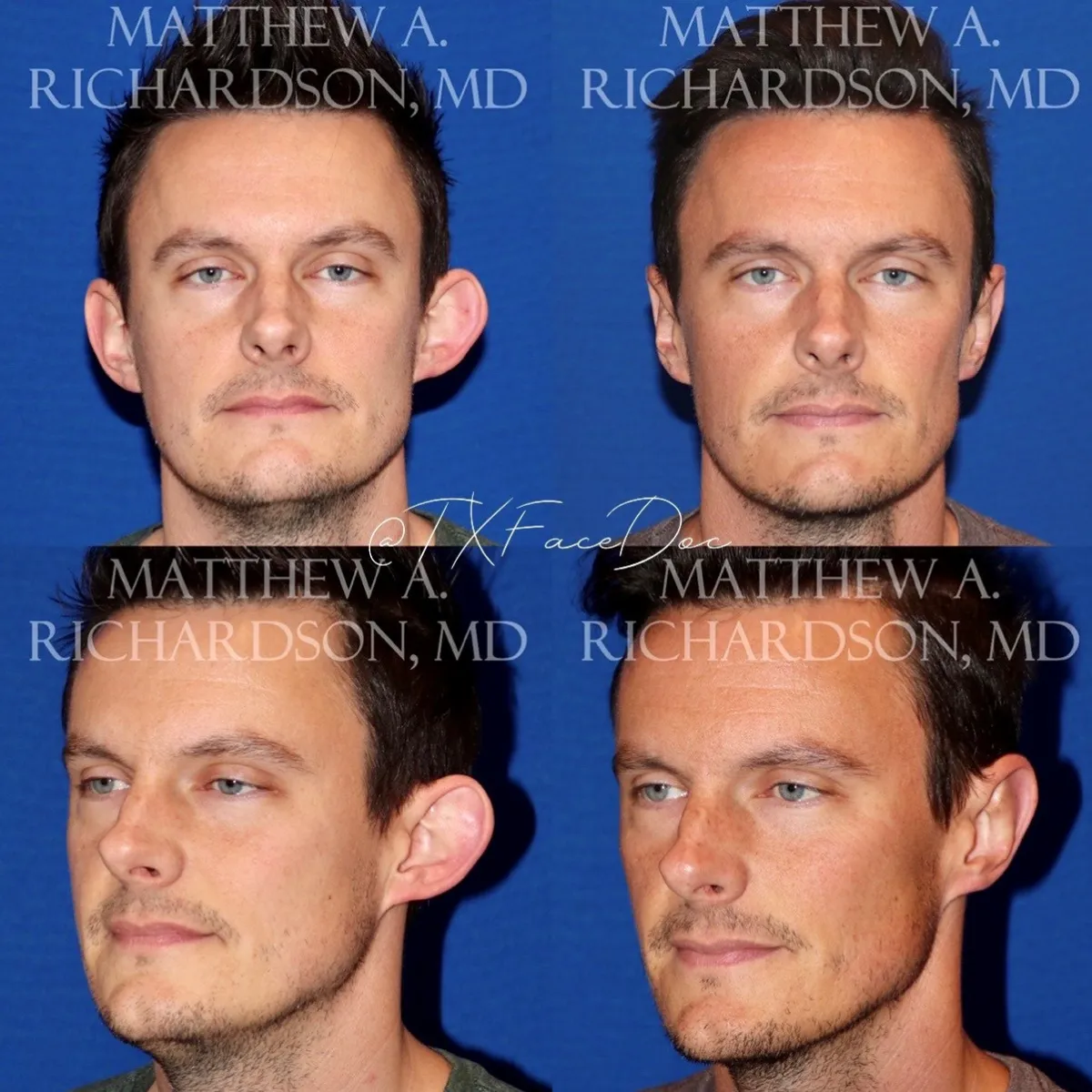Otoplasty Before and After Photos Performed by Matthew A. Richardson, MD