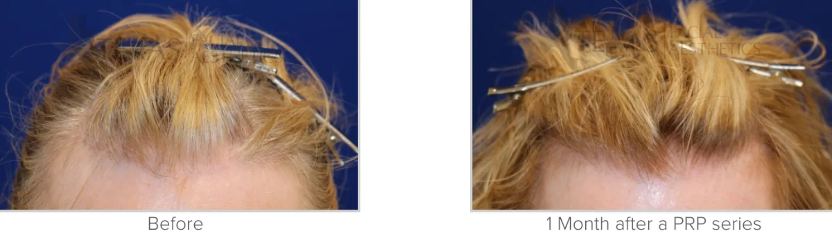 PRP Before and After Performed by Texas Facial Aesthetics