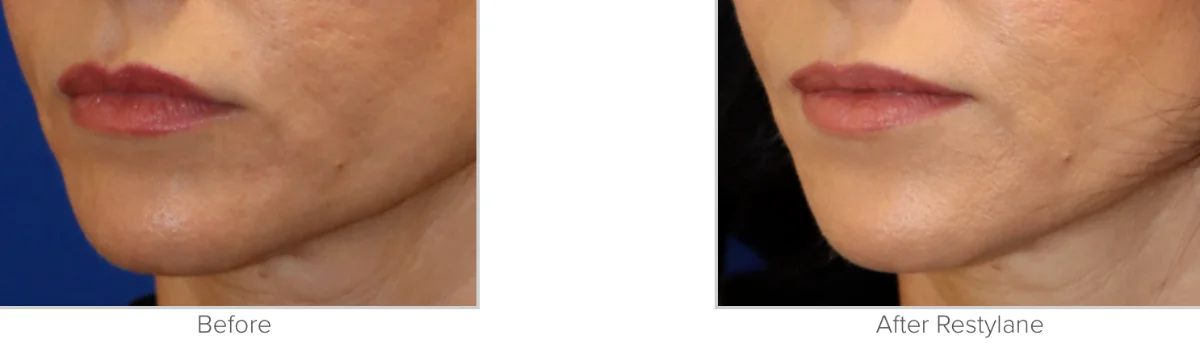 Restylane Before and After Photo Performed by Texas Facial Aesthetics