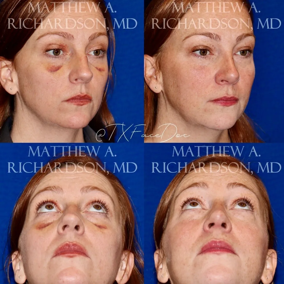 Rhinoplasty before and after performed by Matthew A. Richardson, MD