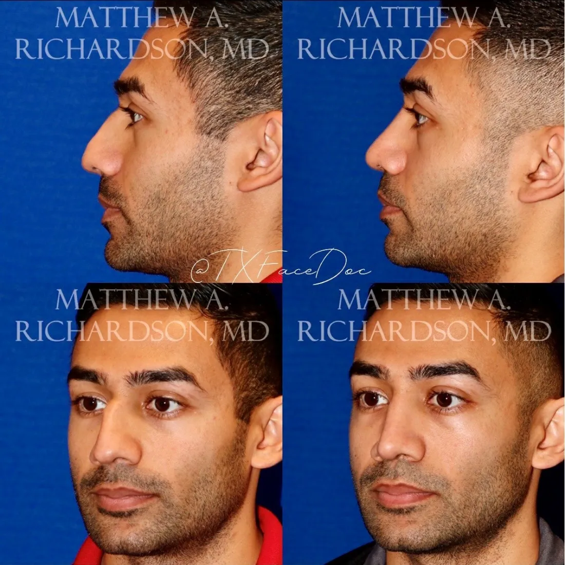 Rhinoplasty before and after performed by Matthew A. Richardson, MD