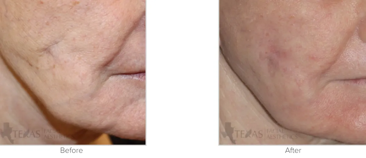 Scar Revision Before and After Performed by Texas Facial Aesthetics