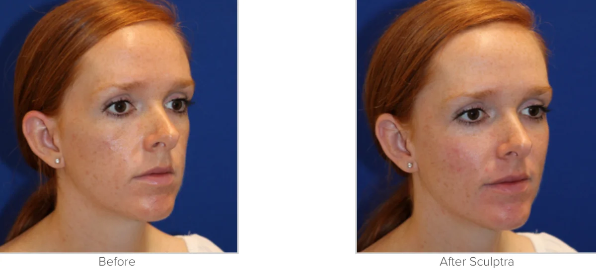 Sculptra Before and After Photo Performed by Texas Facial Aesthetics