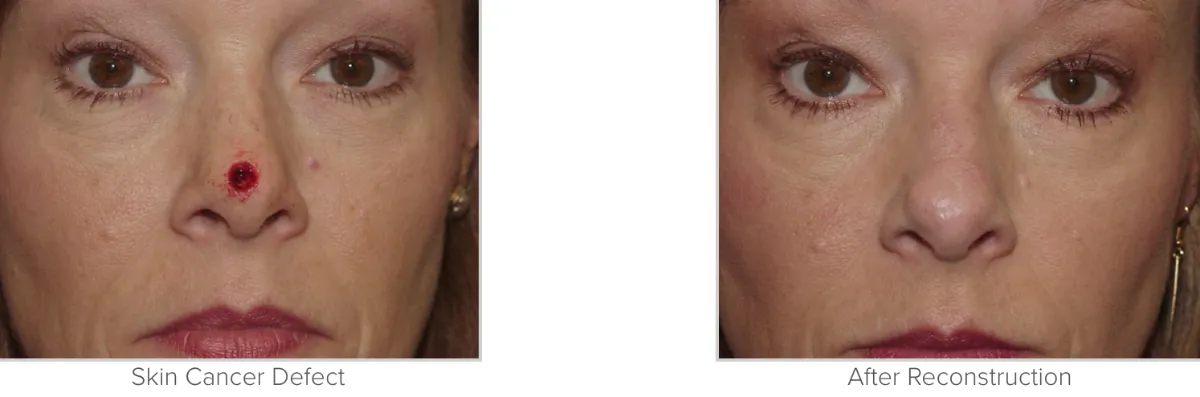 Skin Cancer Reconstruction Performed by Texas Facial Aesthetics